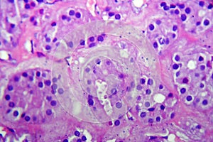 Follicular adenoma of thyroid gland