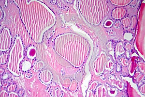 Follicular adenoma of thyroid gland