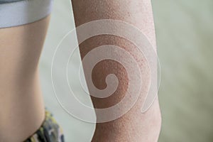 Follicular hyperkeratosis is located on the person`s arm photo