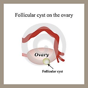 Follicular ovarian cyst. Functional cyst. Infographics. photo