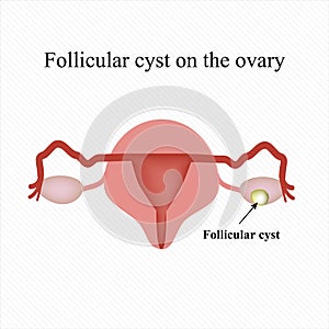 Follicular ovarian cyst. Functional . Infographics. Vector illustration photo