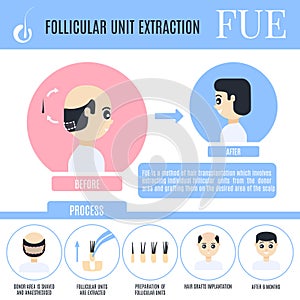 Follicular unit extraction infographics for male alopecia treatment