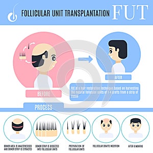 Follicular unit transplantation infographics for male alopecia t