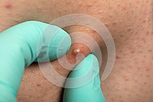 Folliculitis on human skin