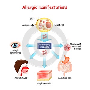 Food allergy and Allergic manifestations. Mast cell