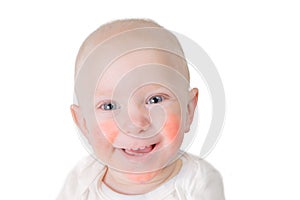 Food allergy concept - baby with dermatitis on cheeks photo