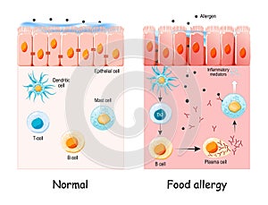 Food allergy.  development of an allergic reaction photo