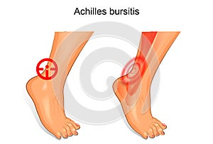 The foot is affected by Achilles bursitis photo
