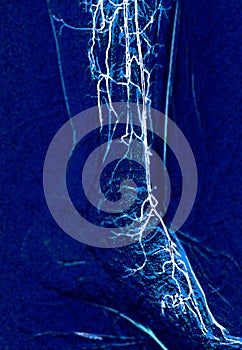 Foot angiorgam or Plantar angiogram angiogram showing  Plantar and Tarsal  Artery at foot area