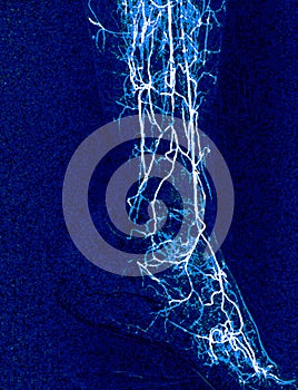 Foot angiorgam or Plantar angiogram angiogram showing  Plantar and Tarsal  Artery at foot area