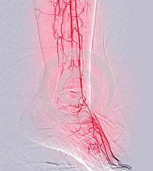 Foot angiorgam or Plantar angiogram angiogram showing  Plantar and Tarsal  Artery at foot area