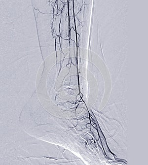 Foot angiorgam or Plantar angiogram angiogram showing  Plantar and Tarsal  Artery at foot area photo