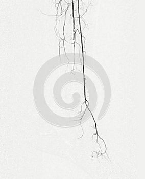 Foot angiorgam or Plantar angiogram angiogram showing  Plantar and Tarsal  Artery at foot area photo