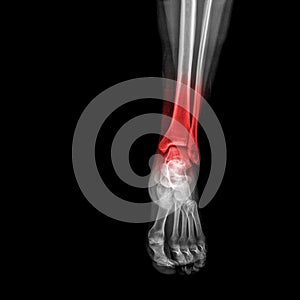 Foot and ankle pain on x-ray, isolated on black background