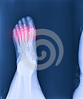 Foot and ankle pain on x-ray, isolated on black background photo