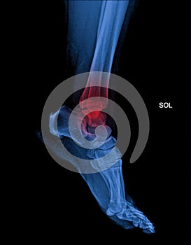 Foot and ankle pain on x-ray, isolated on black background photo