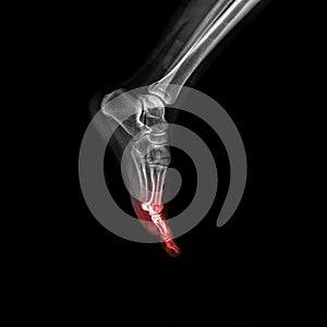 Foot and ankle pain on x-ray, isolated on black background