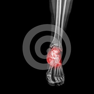 Foot and ankle pain on x-ray, isolated on black background