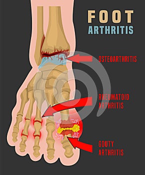 Foot arthritis infographic