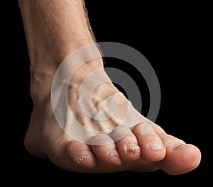 A foot with broken skin on toes