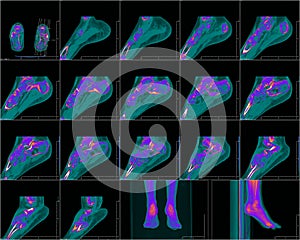 CT foot image