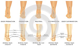 Foot deformation