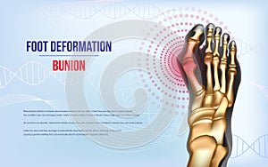 Foot deformation Bunion