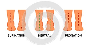 Foot deformation, defect, pathologies of foot, flatfoot. Normal human foot and the foot with supination and pronation
