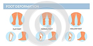 Foot deformation poster. Medical scheme with leg curvature types. Flat, hollow and normal feet. Anatomical pathology