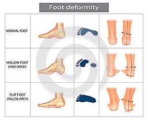 Foot deformation. Types pathologies of foot. Hollow, flat and normal foot.