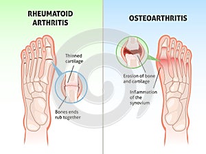Foot disease poster. Medical orthopedic scheme, foot bones defects, joint with rheumatoid arthritis and osteoarthritis