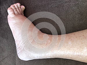 Foot of diseased female patient who suffers from edema illness