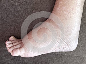 Foot of diseased female patient who suffers from edema illness