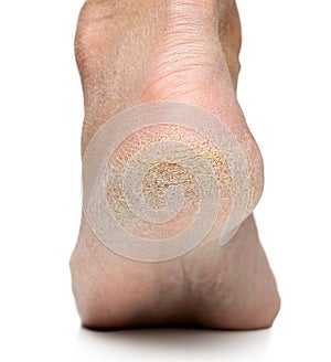 foot dry flaky skin