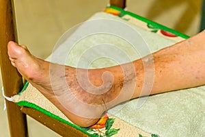 Foot of elderly woman with phlebitis