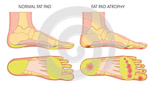 Foot fat pad atrophy photo