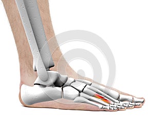 Foot Fracture Metatarsal Bone - Anatomy Male - Studio photo isolated on white