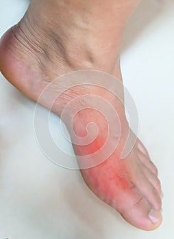 Foot of gout patient.Close up Painful and inflamed