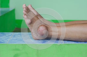 Foot of gout patient photo