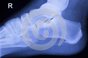Foot heel ankle injury xray scan