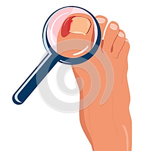 Foot with ingrown toenail.Disease, fungus or inflammation in fingernails.