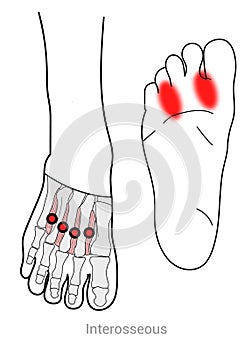 Foot Interosseous muscles and toe pain