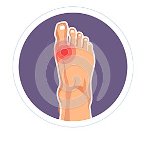Foot joint injury toe pain arthritis or skeletone damage photo