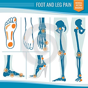 Foot and leg pain. Arthritis and rheumatism orthopedic medical vector diagram photo