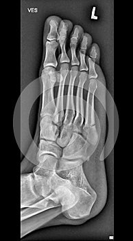 Foot medical xray, lower limb bones