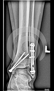 Foot medical xray, lower limb bones, broken ankle, tibia fibula with screws