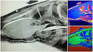Foot mri metatarsal shaft stress fracture collage