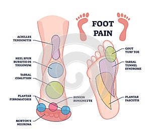 Foot pain causes from zones diagnosis and painful spots areas outline diagram photo