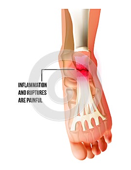 Foot pain, plantar fasciitis inflammation and ruptures strain bottom view. Realistic anatomy illustration