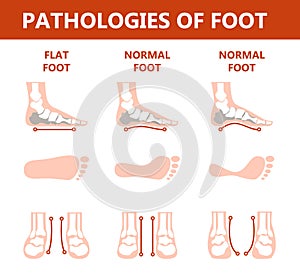 Foot pathologies infographic. Flat foot anatomy. Deformed